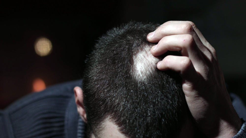 Alopecia areata: una patologia ancora alla ricerca di una vera e propria collocazione in ambito sanitario 1